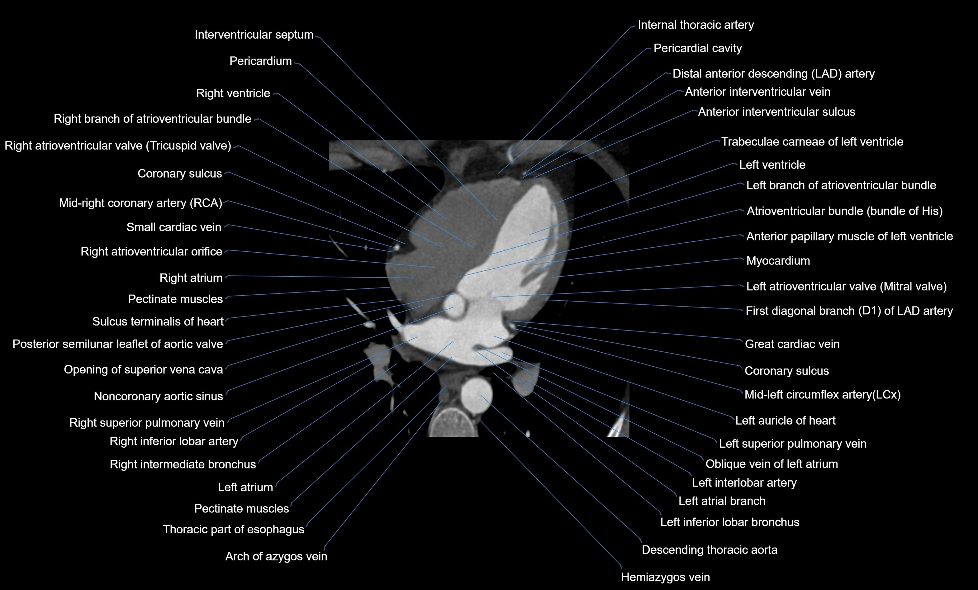 CT heart (coronary angiogram) four chamber view  cross sectional anatomy labelled radiology image -00027.webp